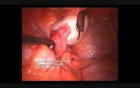Ovarian Fenestration and Chromopertubation 
