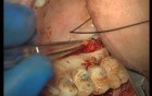 Reconstruction Of Adhesive Gingiva (3/5)