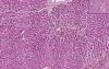 Chronic passive congestion with hemorrhagic centrilobular necrosis - Histopathology of liver