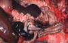 Hemodynamic Disorders, Thromboembolic Disease and Shock - MSP - 4d
