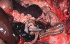 Hemodynamic Disorders, Thromboembolic Disease and Shock - MSP - 4d
