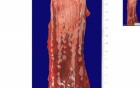 Barrett esophagus 2 - Histopathology - Esophagus