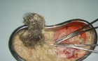 Dermoid Sebacious Material And Hair, 2