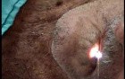 Reterograde Endoscopy - The Endoscope Exits Through The Mouth