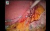 Laparoscopic Sleeve Gastrectomy in 10 steps - Part 2