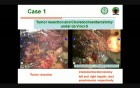 Hilar Cholangiocarcinoma Treatment With Surgical Robot