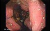 Presence of Multiple Irregular and Large Ulcers - Retroflexed View, Part 2