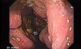 Presence of Multiple Irregular and Large Ulcers - Retroflexed View, Part 2