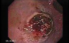 Gastrointestinal Stromal Tumor - GIST (10 of 65)