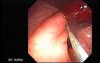 Duodenal Ulcer and Bleeding (3 of 23)