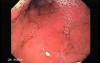 Scirrhous Gastric Carcinoma - Endoscopy (1 of 47)