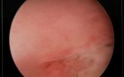 Excessive Proliferation of the Cells of the Endometrium - Endometrial Hyperplasia