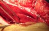 Intestinal resection in incisional hernia