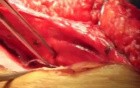 Intestinal resection in incisional hernia