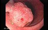 Tubulo-Villous Adenoma (3 of 6)