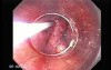 Early Gastric Cancer of the Gastroesophageal Junction - Procedure of Mucosectomy, Part 2