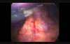 Laparoscopic Splenectomy