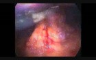 Laparoscopic Splenectomy