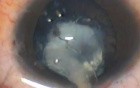 Sommering Ring Cataract - Fugo Plasma Capsulotomy