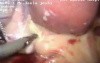 Sleeve gastrectomy with cholecystectomy and mesh hernioplasty