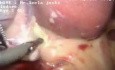 Sleeve gastrectomy with cholecystectomy and mesh hernioplasty