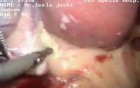 Sleeve gastrectomy with cholecystectomy and mesh hernioplasty