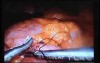 Jejunal Gastrointestinal Stromal tumor (GIST) (33 of 86)