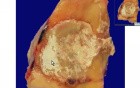 Gout - Histopathology - Interphalangeal joint of toe