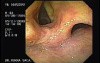 Acute Variceal Bleeding - Yellowish of the Laryngeal Mucosa