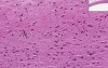 Atherosclerosis with fatty streak - Histopathology - Aorta