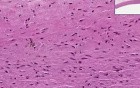 Atherosclerosis with fatty streak - Histopathology - Aorta