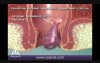 Rubber Band Ligation for Hemorrhoids - 3D Medical Animation