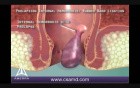 Rubber Band Ligation for Hemorrhoids - 3D Medical Animation