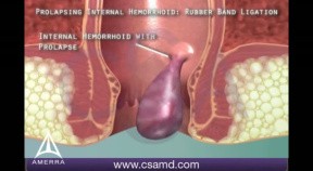 Rubber Band Ligation for Hemorrhoids - 3D Medical Animation