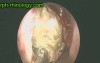 Conchal Cell Disease
