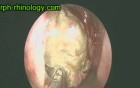 Conchal Cell Disease