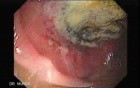 Non - Hodgkin's Lymphoma Of The Colon (4 of 16)