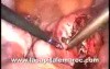 Laparoscopic Polymyomectomy (Bicornuate Uterus)