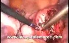 Laparoscopic Polymyomectomy (Bicornuate Uterus)