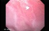 Endoscopic view of Barrett Esophagus (1 of 9)