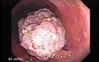 Large Tubulo-Villous Adenoma (6 of 6)