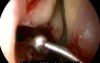 Microdebrider Uncinectomy