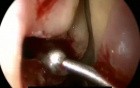 Microdebrider Uncinectomy
