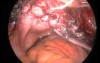 Sacrocolpoplexy by Use of Laparoscopic Method