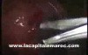 Laparoscopic Myomectomy Using The Roders Knots