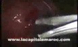 Laparoscopic Myomectomy Using The Roders Knots