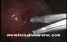 Laparoscopic Myomectomy Using The Roders Knots