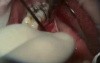 How To Cover Recession Caused By Tongue Piercing