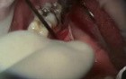 How To Cover Recession Caused By Tongue Piercing