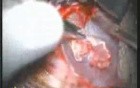 Myringoplasty Part 1